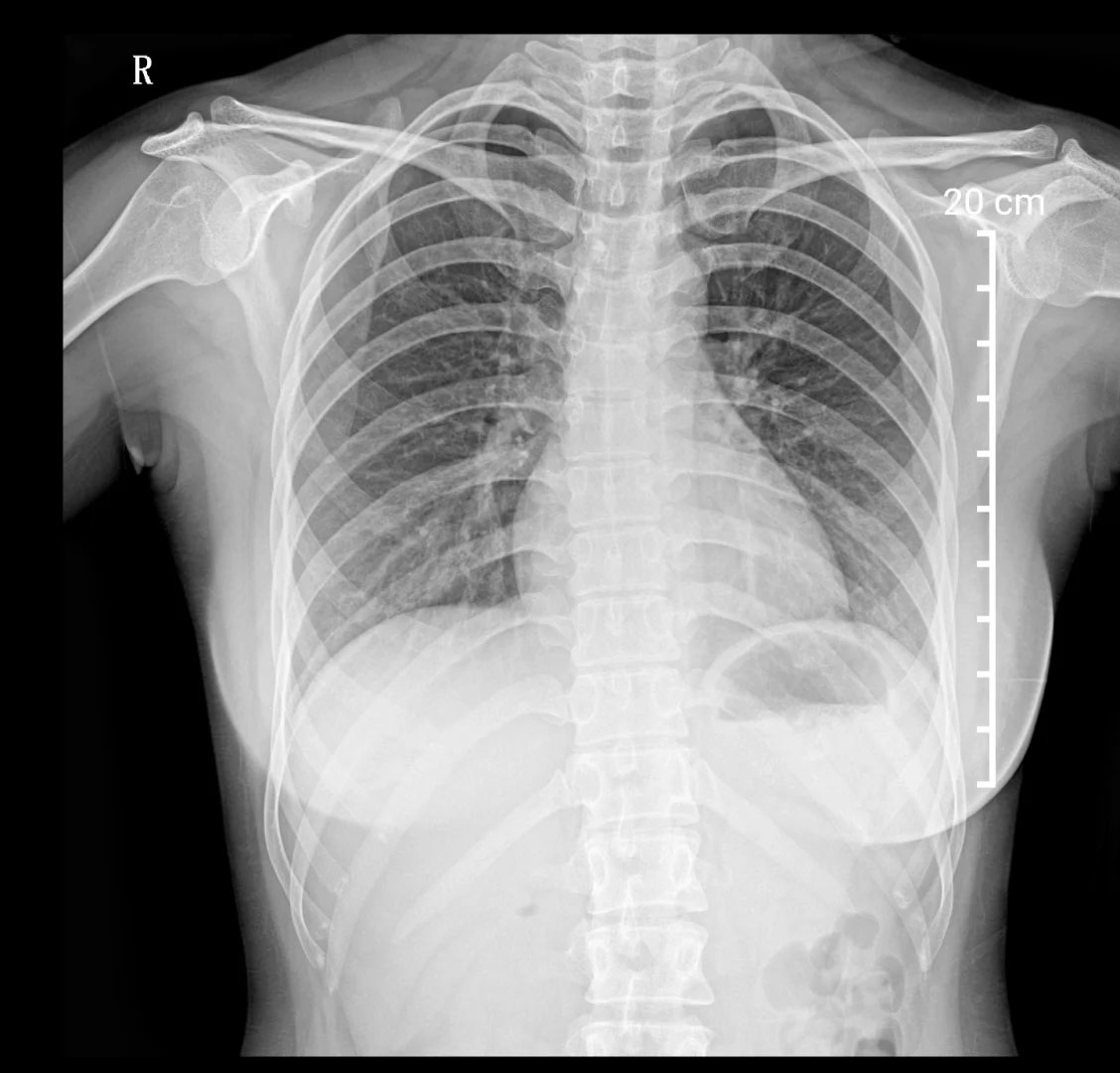 胸部X光檢查.jpg